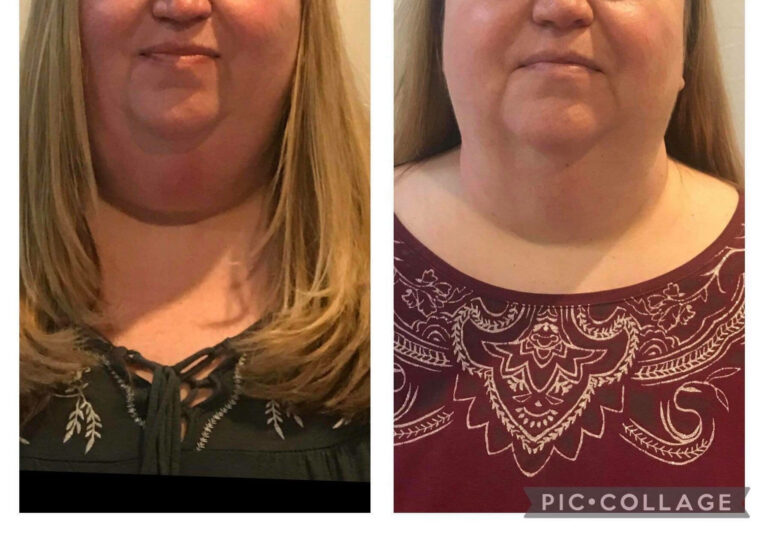 Double-Chin-4-slimming-1-toning