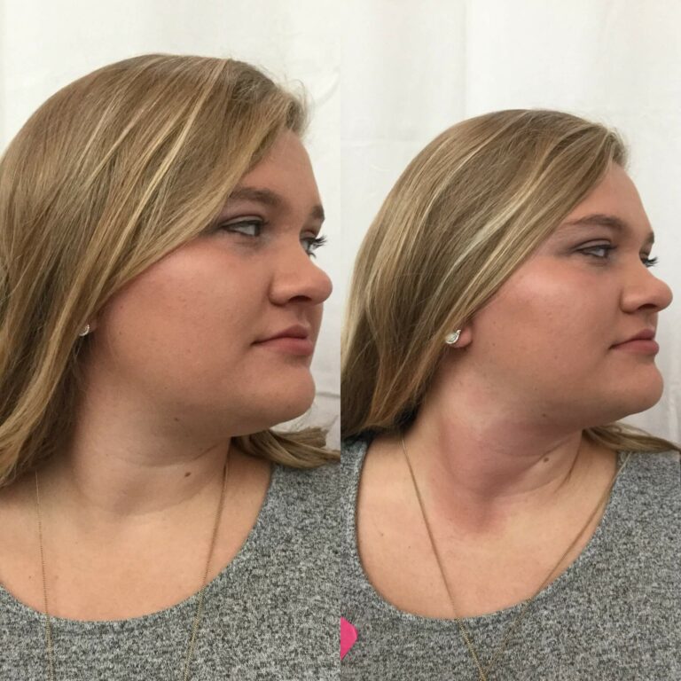 Double-Chin-Before-After-1