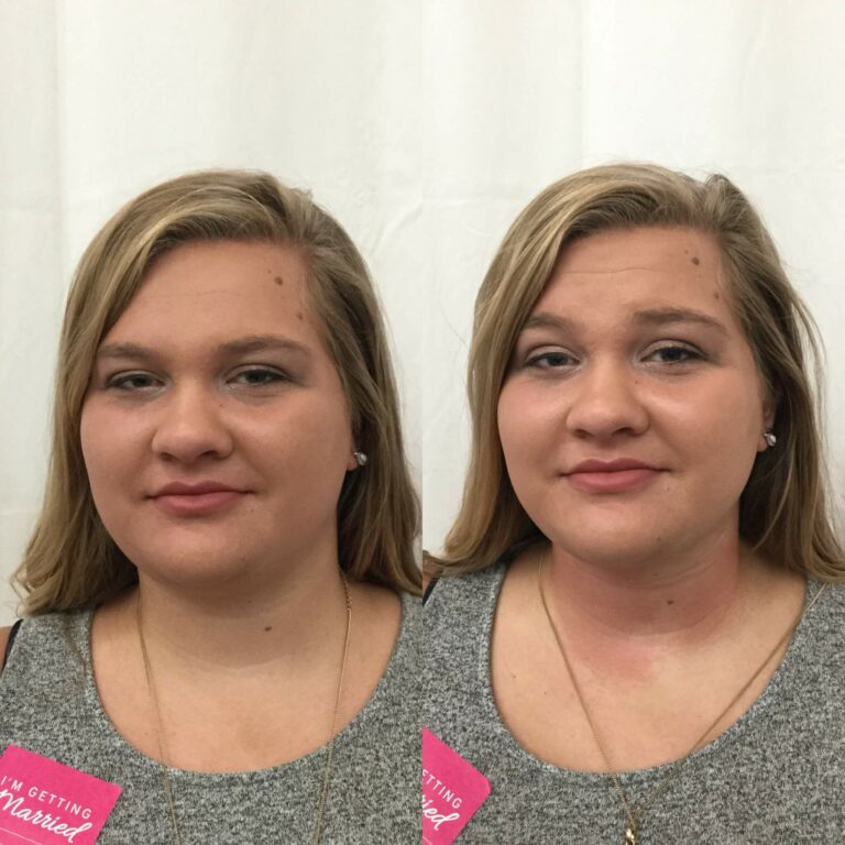 Double-Chin-Before-After-3