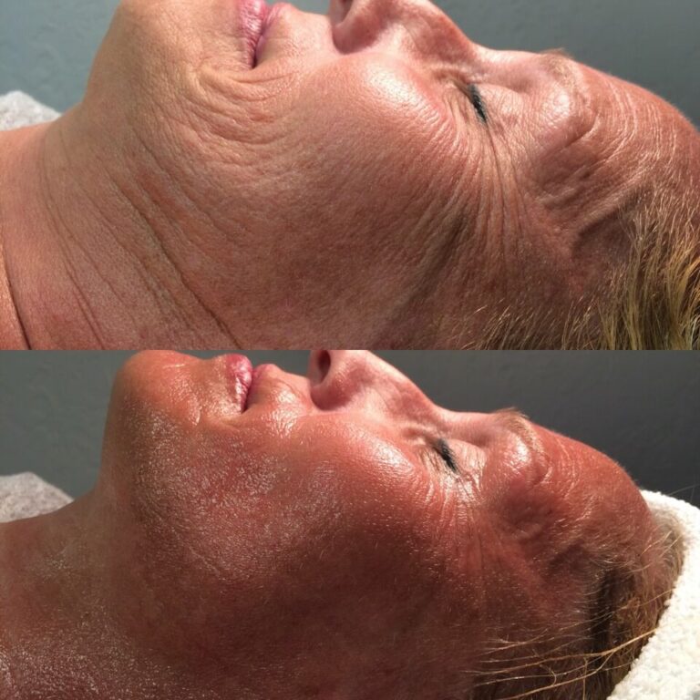 Facial-Side-Before-After