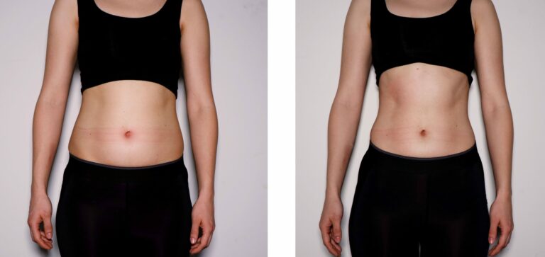 Female-Abdomen-Toning-Before-After-scaled