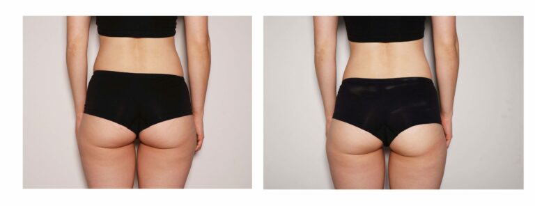 Female-Butt-Toning-Before-After-scaled