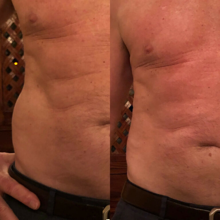 Love-Handles-Before-After